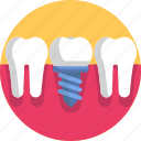 dental, dental implant, dentist, dentistry, root canal, dental treatment, tooth