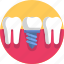 dental, dental implant, dentist, dentistry, root canal, dental treatment, tooth 