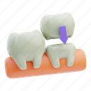crown, care, treatment, dental, health, medical, medicine, tooth, mouth 