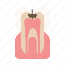 caries, dental, dentist, dentistry