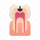 caries, cavity, decay, tooth