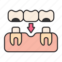 bridge, implant, dentist, tooth