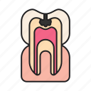 caries, cavity, decay, tooth