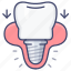 dental, implant, implantation, tooth 